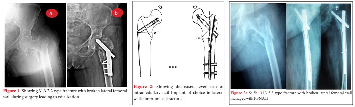 Intramedullary Nail Versus Dynamic Hip Screw; Intramedullary Nail  (Advantages And Disadvantages)