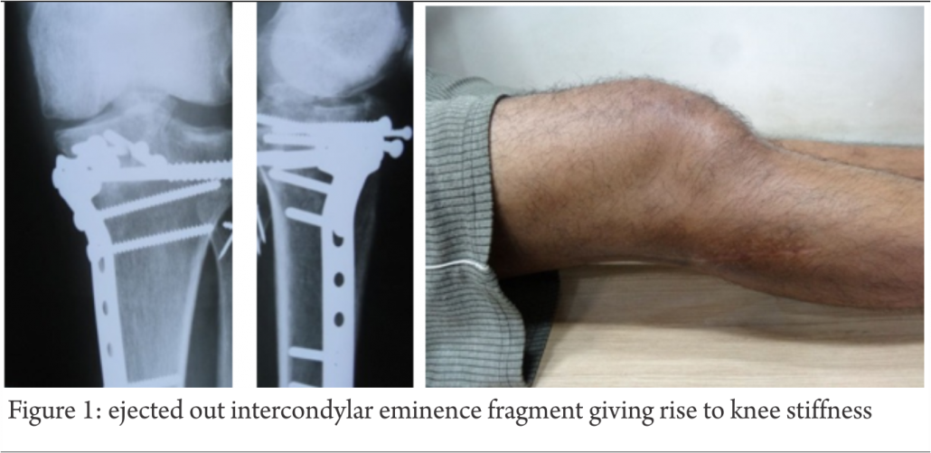 Tibia eminence fracture Archives Trauma International