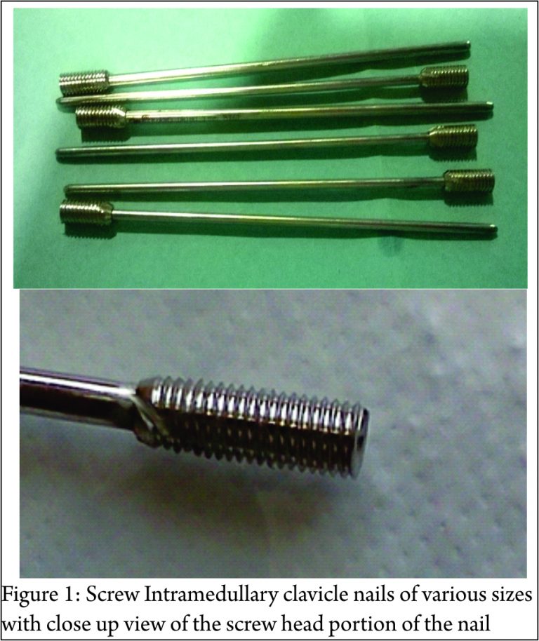 The Screw Intramedullary Elastic Nail Fixation in fresh Displaced Mid