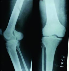 Figure 2: Hoffa's fracture –B3.