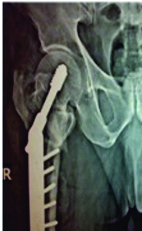 Figure 2: immediate post-operative X-ray showing good, stable fixation