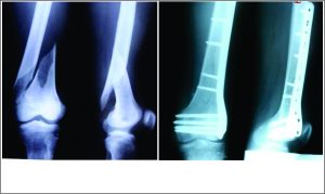 Figure 2: Treatment of simple spiral fracture of distal femur (33A2) in a 32 year old young male by open, compression plating with DF-LCP. DCS could have been used here, instead of DF-LCP. Fig 2A Pre-operative x-rays Fig 2B 3 month post-operative x-rays