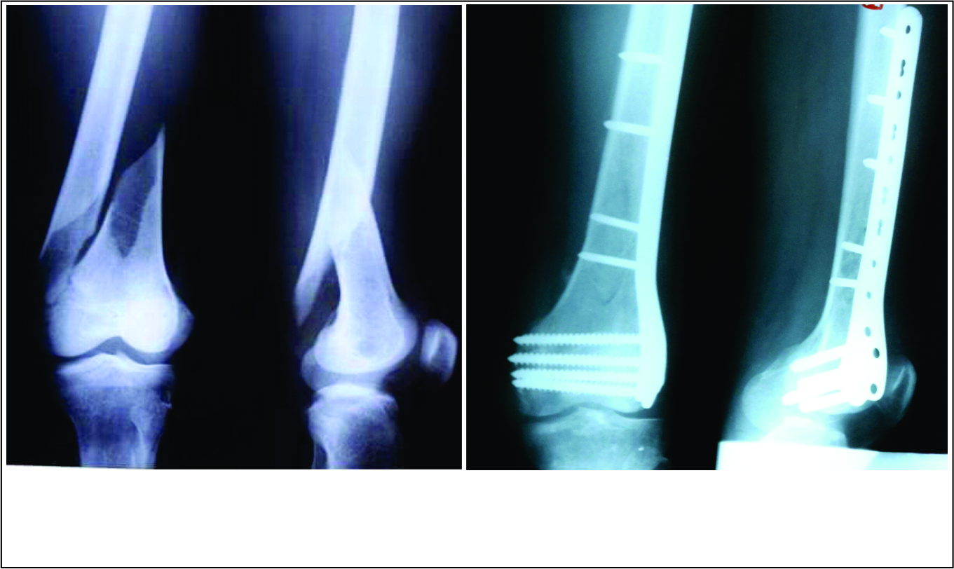Pictures Of Spiral Fractured Femur 69