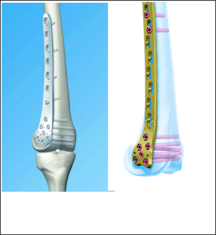 Figure 3: Designs of common locking compression plates (LCP) used for distal femur Fig 3A Distal femur Locking Compression Plate (DF-LCP) Fig 3B Condylar LCP