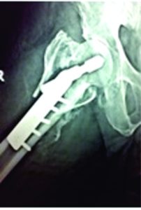 Figure 4: fracture reduced and Abduction brace was provided to maintain the reduction