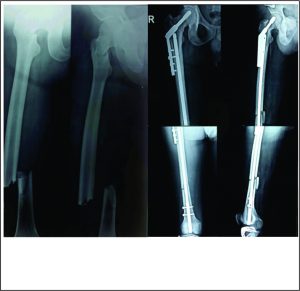 Figure 4: Rendezvous fixation of ipsilateral femoral neck (31B2.3) and shaft (32B2.2) fractures with a DHS-retrograde nail combination Fig 4A Pre-operative x-rays Fig 4B Immediate post-operative x-rays