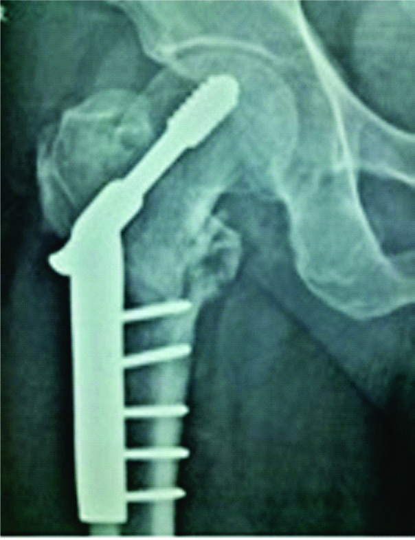 Figure 6: immediate post-operative X-ray showing good, stable fixation