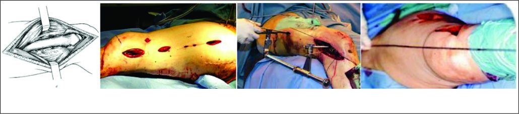 Figure 6: Surgical approaches and reduction techniques for distal femur Fig 6A Standard open, lateral approach to distal femur Fig 6B MIPO approach to distal femur Fig 6C Use of intra-op distractor for indirect reduction Fig 6D Use of cautery cord intra-operatively to judge limb alignment