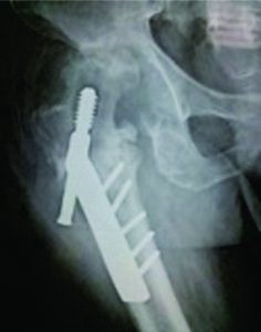 Figure 6: immediate post-operative X-ray showing good, stable fixation