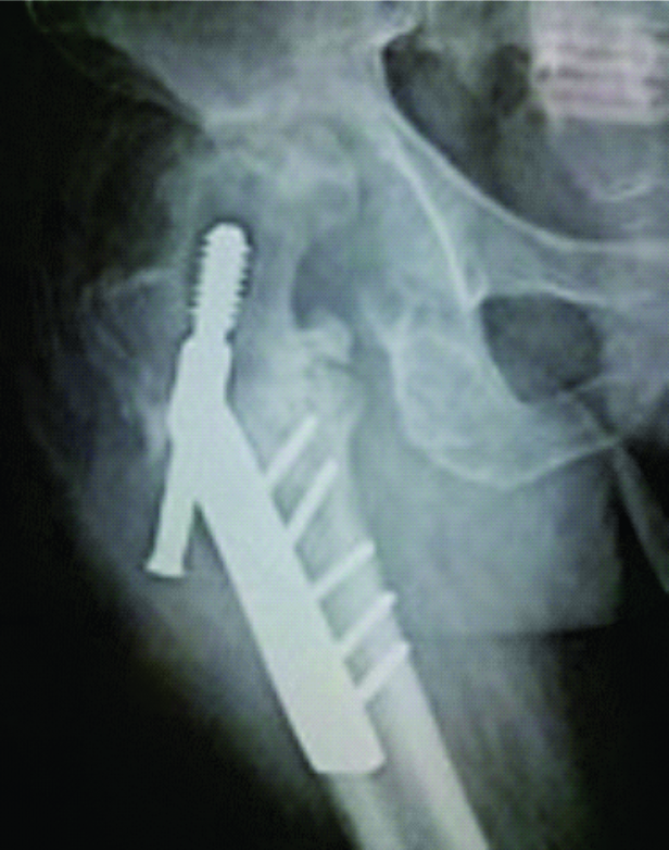 Figure 7: At 10 months follow-up, X-ray showed subluxation of hip joint