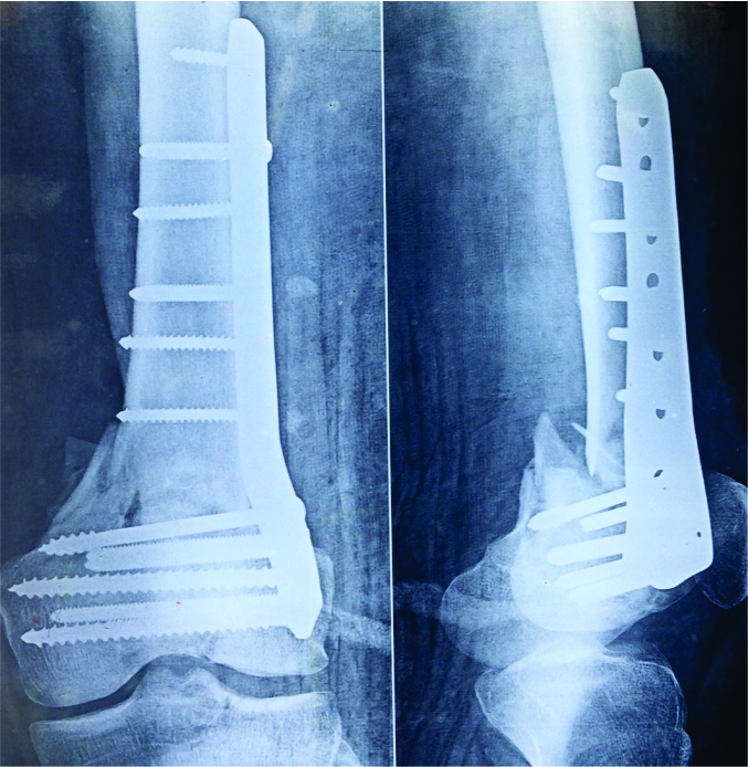 Figure 8: Malreduction of distal femur fracture.